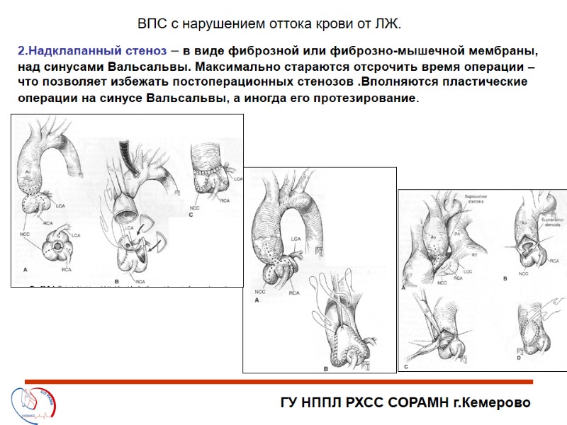 ГУ НППЛ РХСС СОРАМН г.Кемерово ВПС с нарушением оттока крови от ЛЖ. 2.Надклапанный стеноз